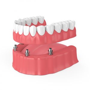 Removable Full Implant Denture